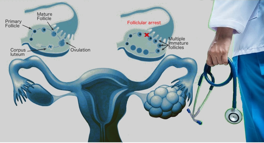 Polycystic Ovarian Disease